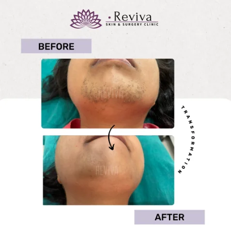 Before and after result 13