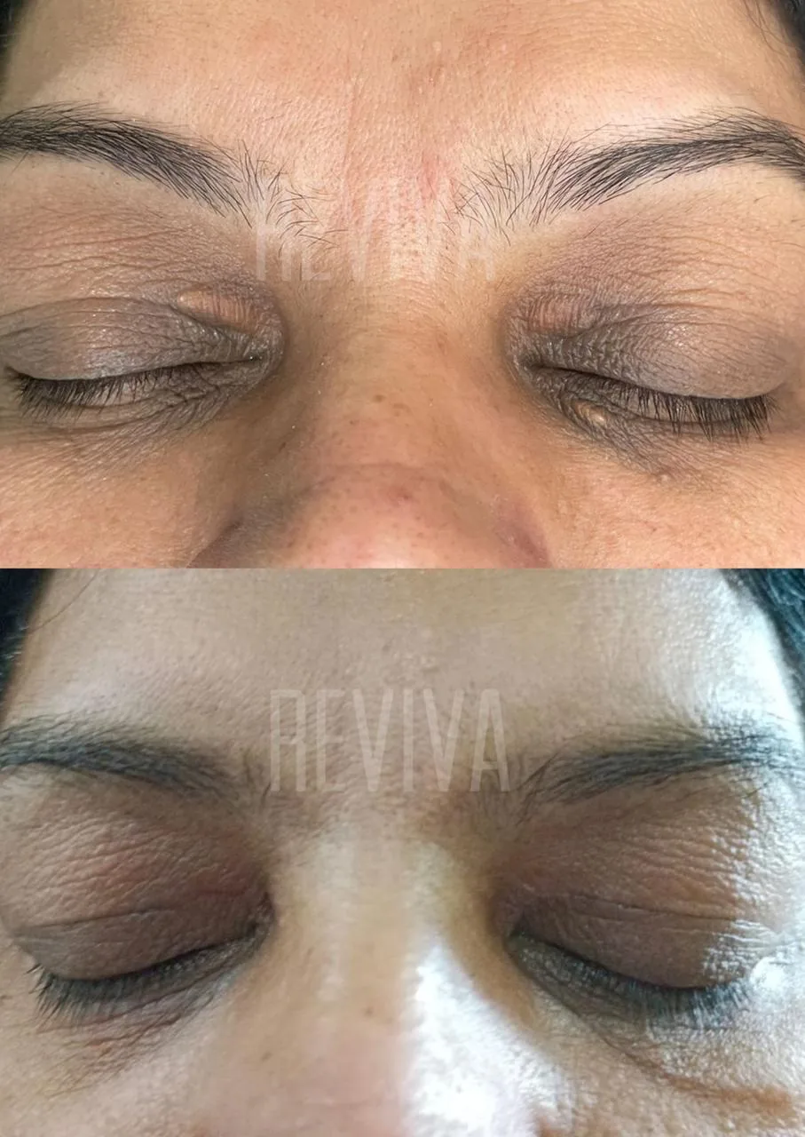 Before and after result 23